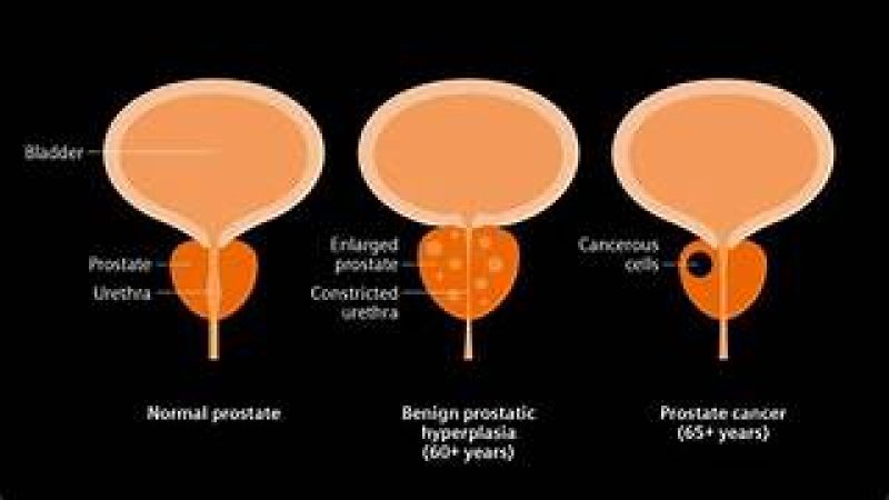 prostate
