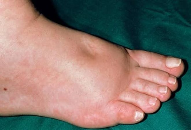 swollen feet