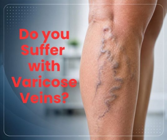 varicose veins final